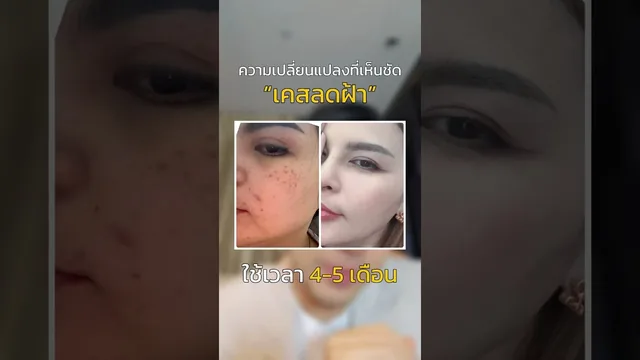 ฝ้าจางเพราะดวงดี…จับฉลากได้ SET ลดฝ้า